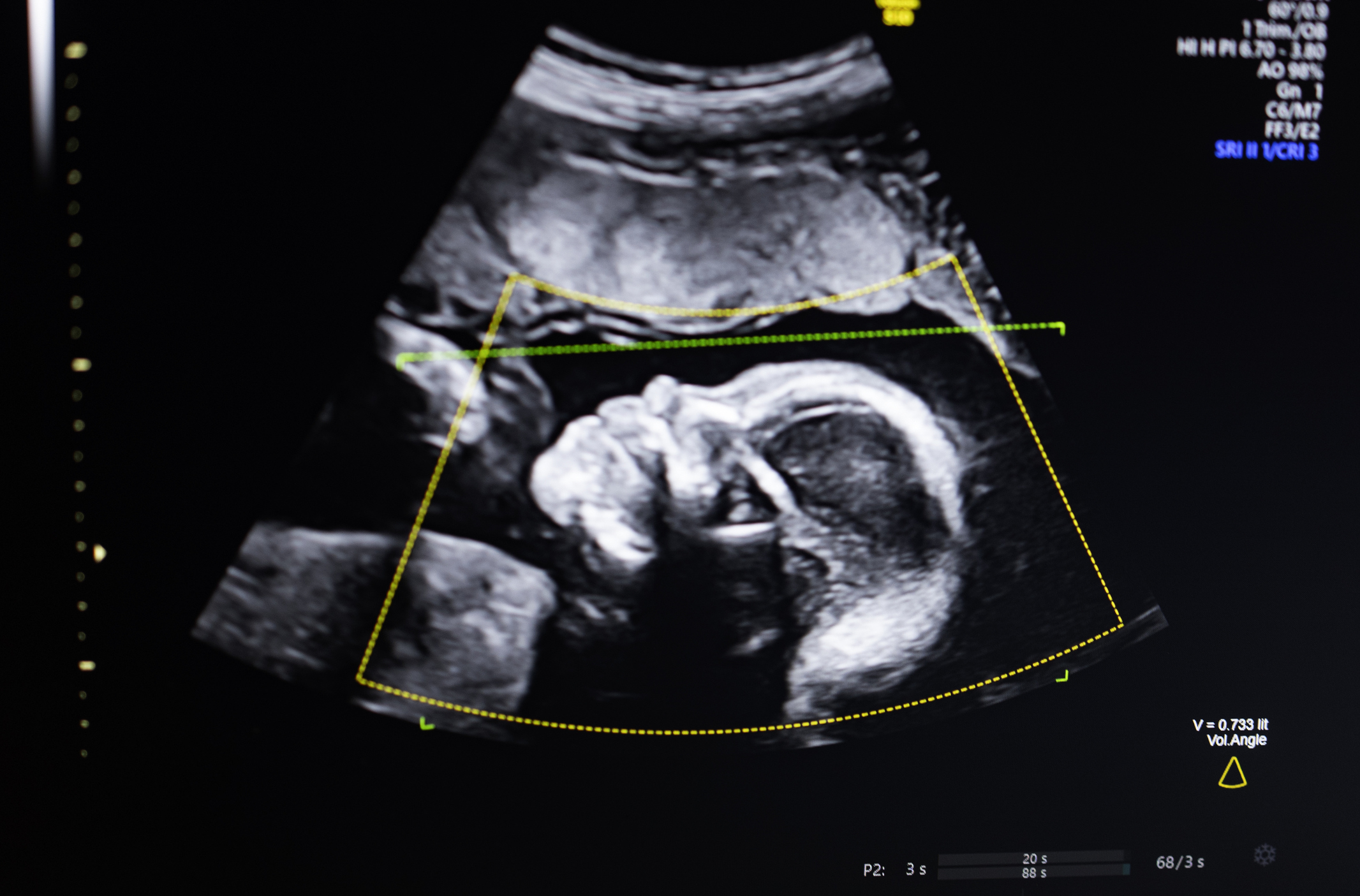 Ultrasound of a baby in a womb